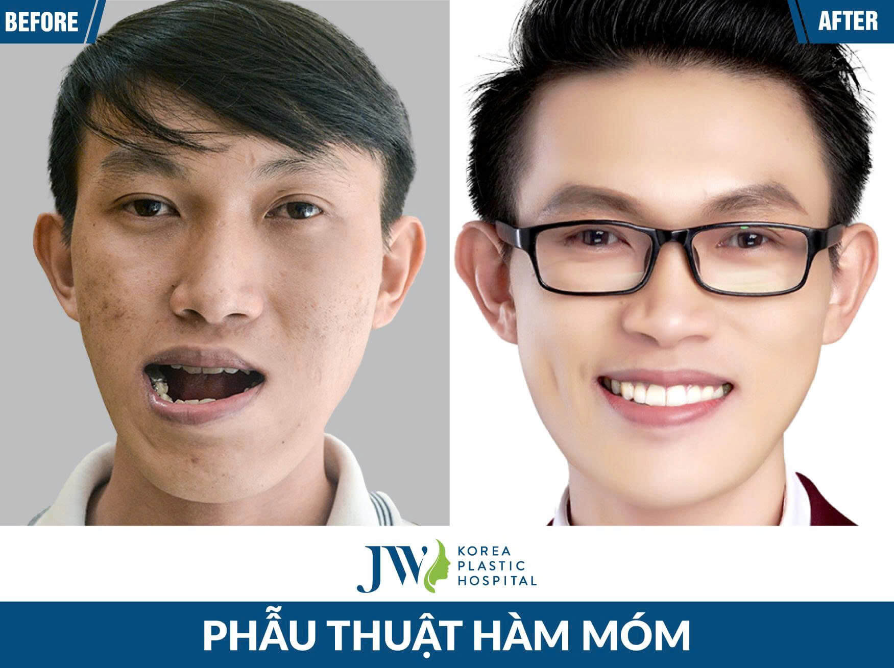 phau thuat ham mom
