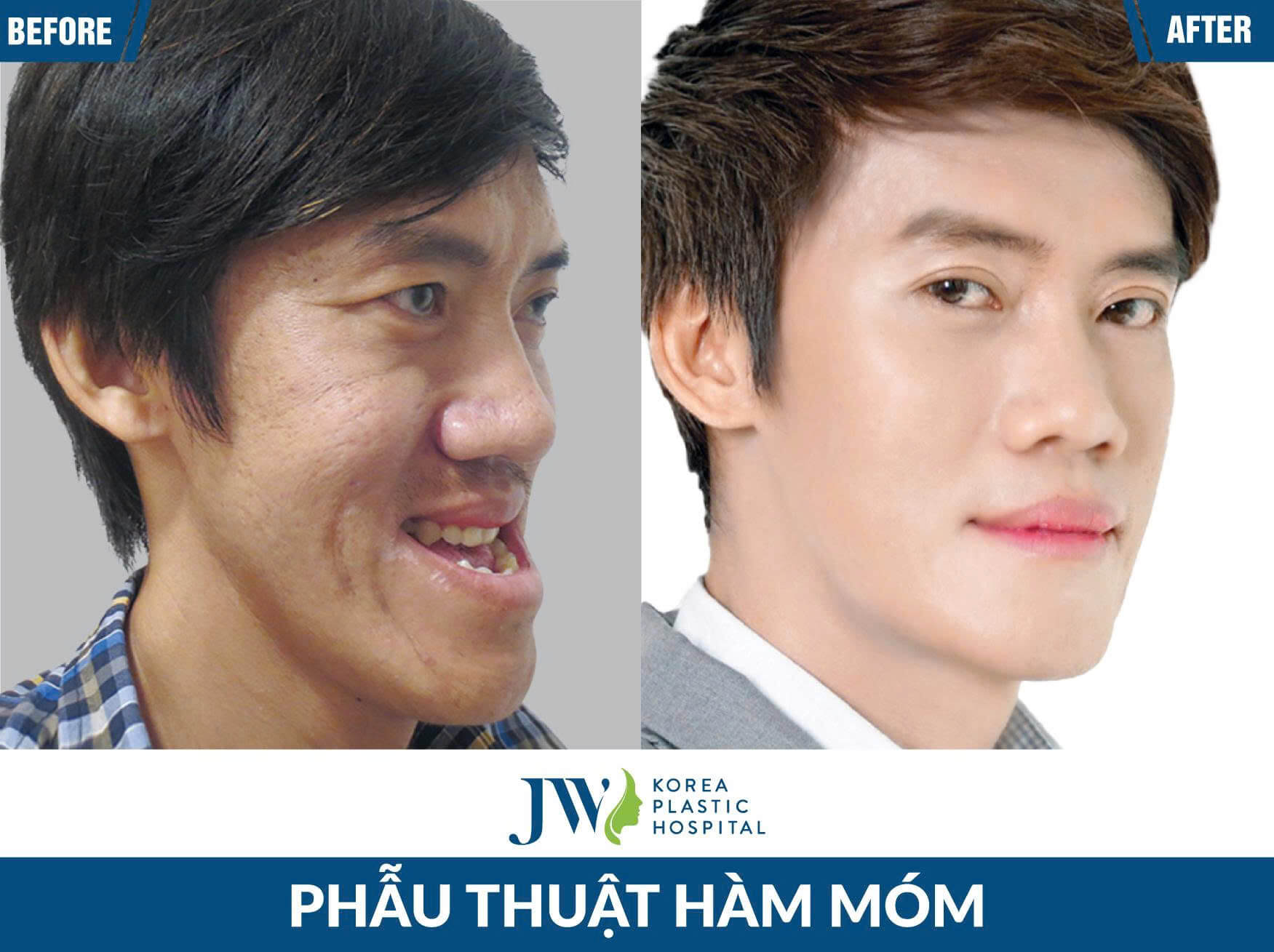 phau-thuat-ham