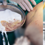 Ca đầu tiên tại Việt Nam nạo biến chứng filler bằng siêu âm AI