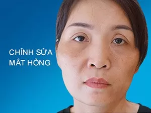 Chỉnh sửa mắt hỏng
