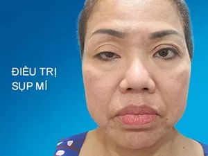 Điều trị sụp mí