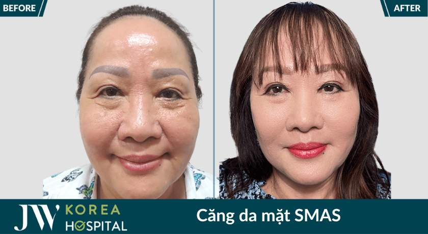 hinh truoc sau cang da mat