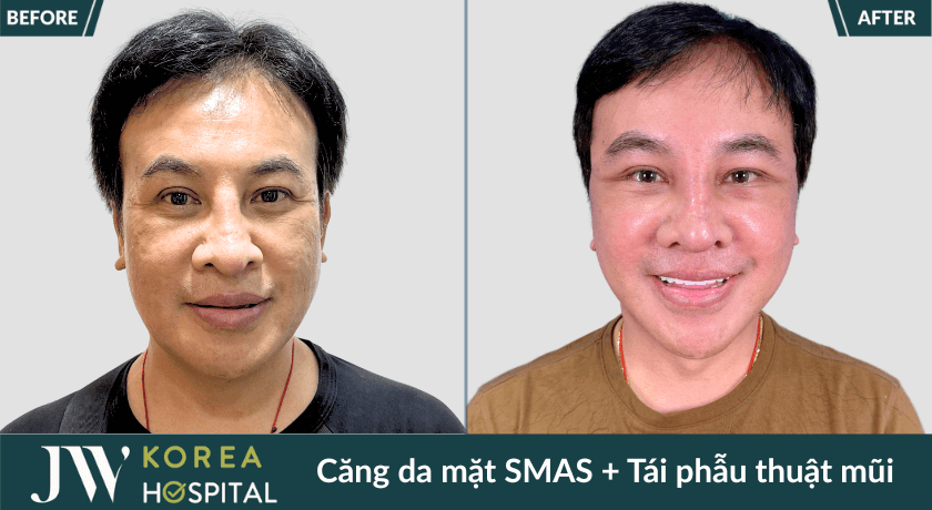 truoc va sau cang da mat