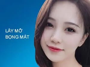 Lấy mỡ bọng mắt
