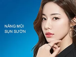 Nâng mũi sụn sườn