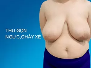Thu gọn ngực chảy xệ