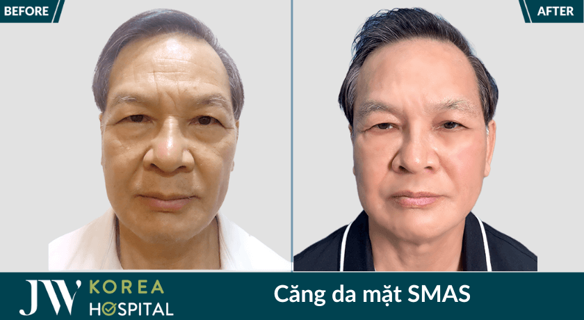 hinh truoc sau cang da mat