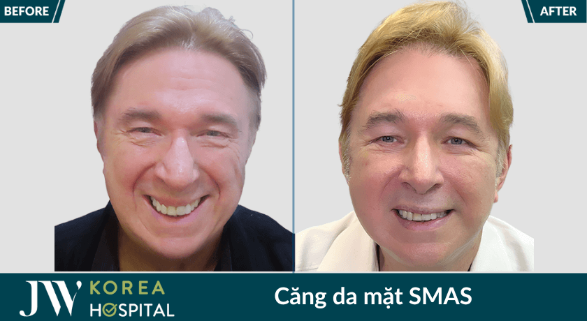 hinh truoc sau cang da mat