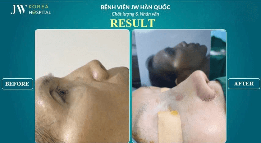 hình ảnh trước và sau tại phẫu thuật mũi hỏng
