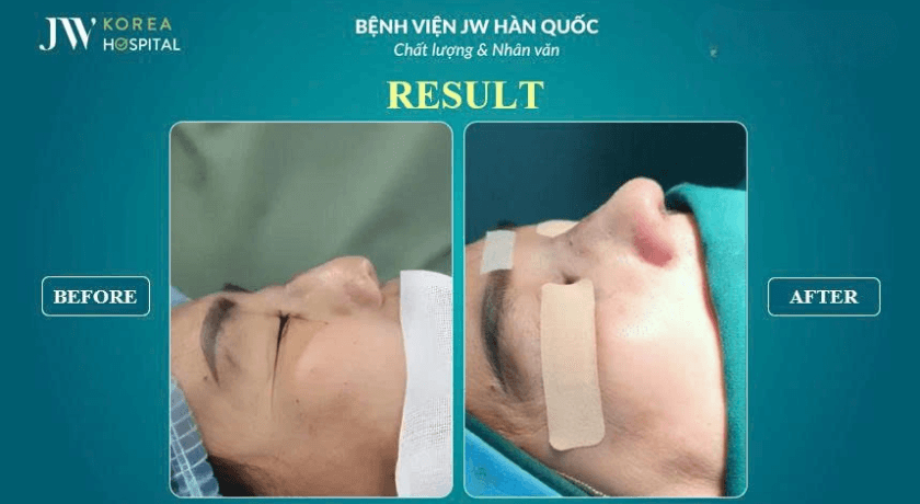 nâng mũi sụn sườn tái phẫu thuật tại JW