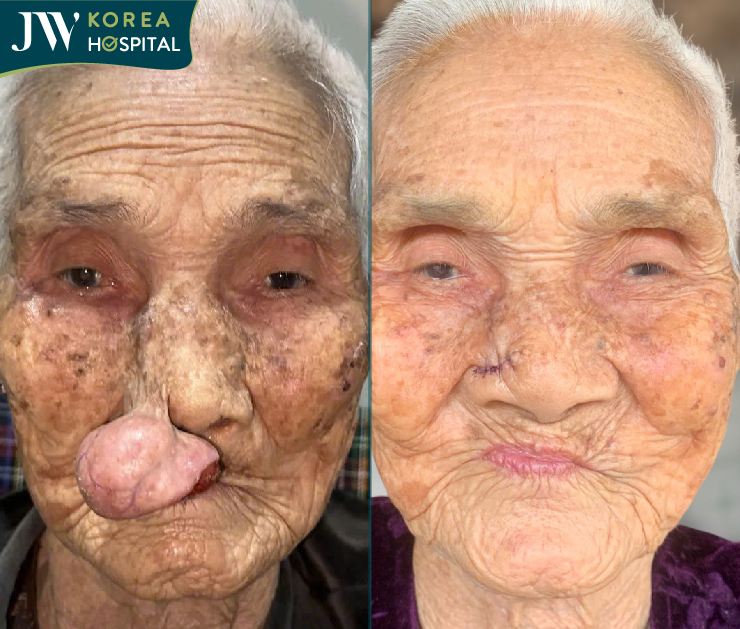 Hình ảnh trước và sau của cụ bà 100 tuổi khi đến Bệnh viện JW