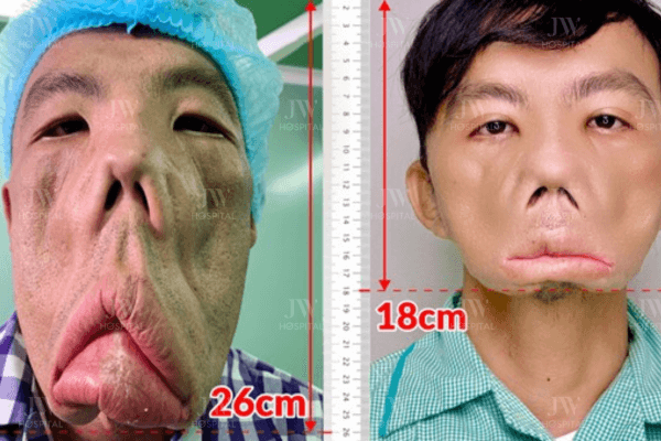 anh mến trước và sau phẫu thuật tại bệnh viện jw