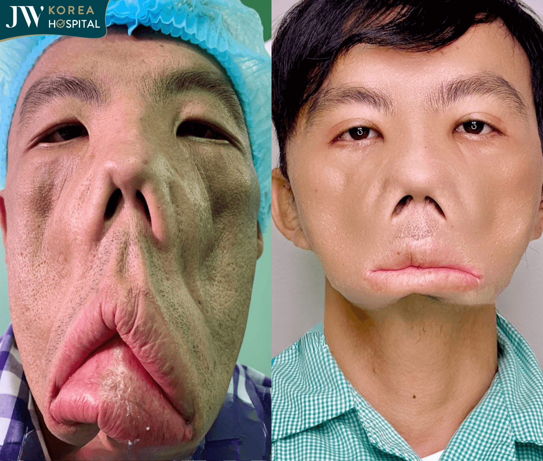 Hình ảnh trước và sau của anh Mến khi đến Bệnh viện JW