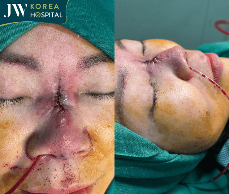 bác sĩ tú dung điều trị mũi biến chứng