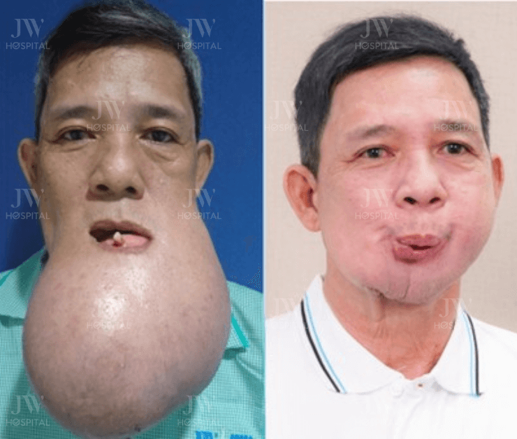 chú khanh khối u khổng lồ