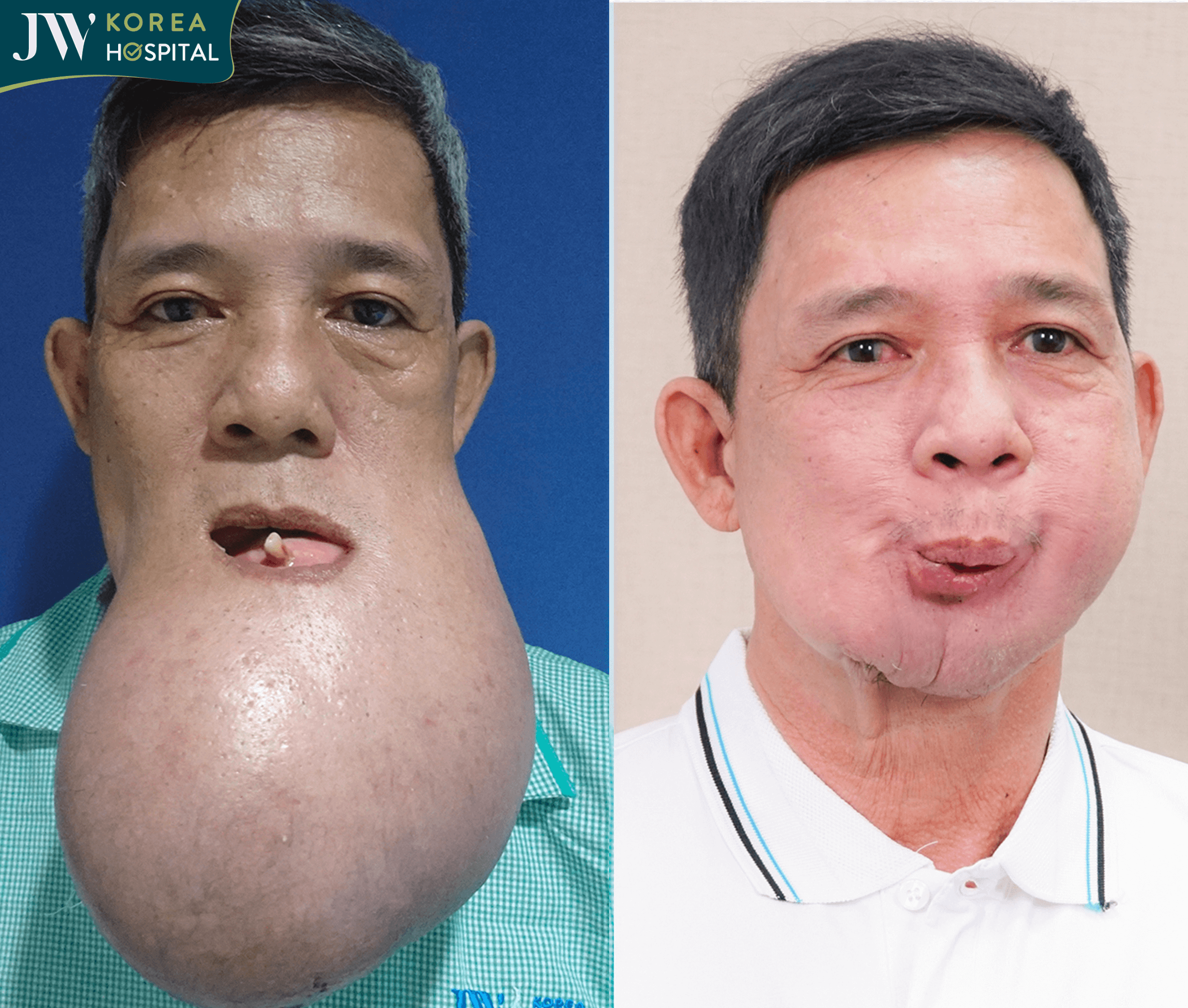 Hình ảnh trước và sau của chú Khanh khi đến Bệnh viện JW 