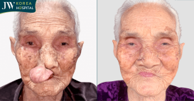 cụ bà 100 tuổi cắt khối bướu quỷ