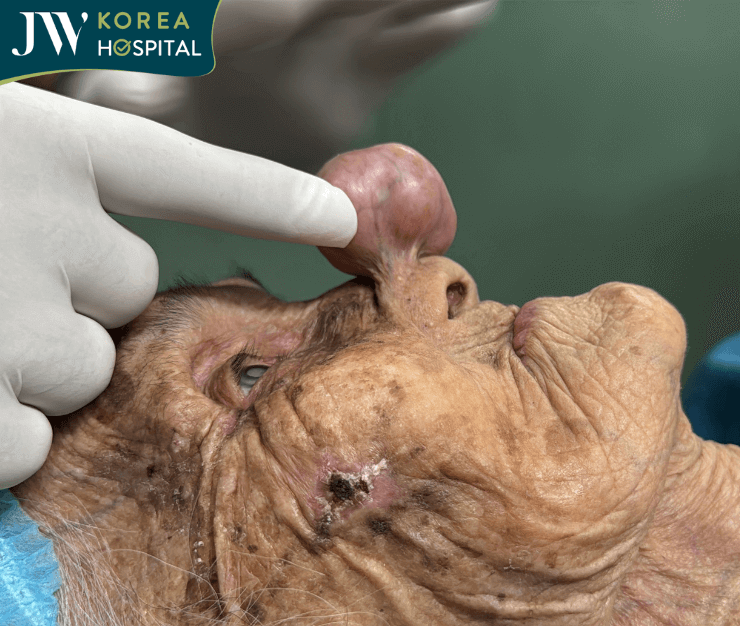 cụ bà chuẩn bị phẫu thuật cắt khối u