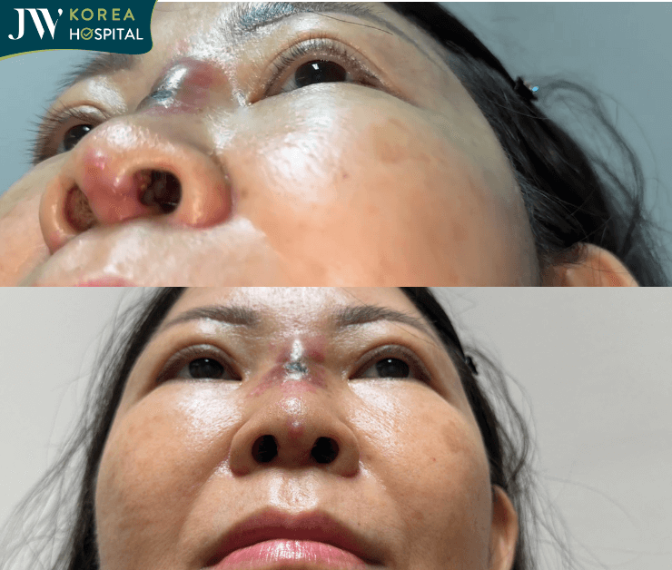 hoại tử mũi do nâng mũi phong thủy