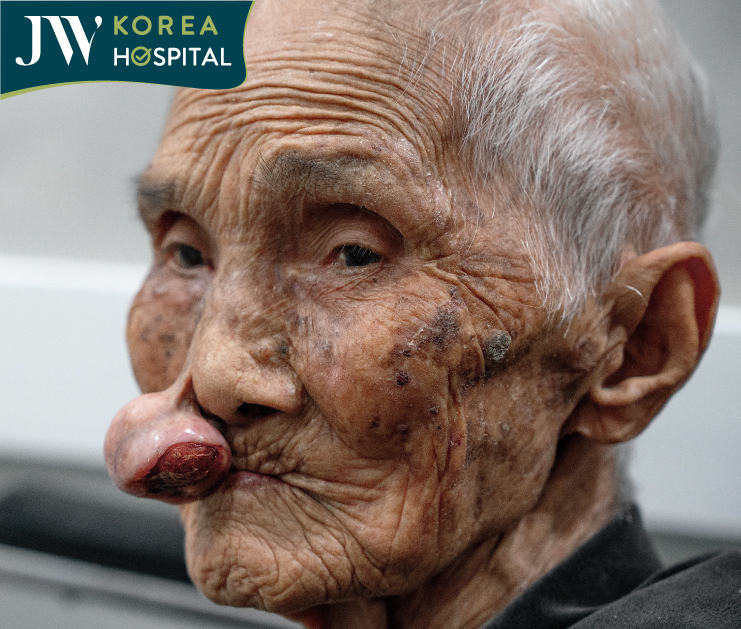 Cụ bà 100 tuổi với khối u mạch máu chèn ép đường thở hơn 30 năm