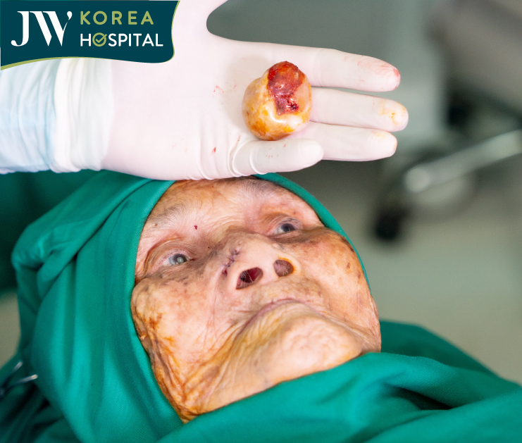 hình ảnh khối u của cụ được cắt bỏ 