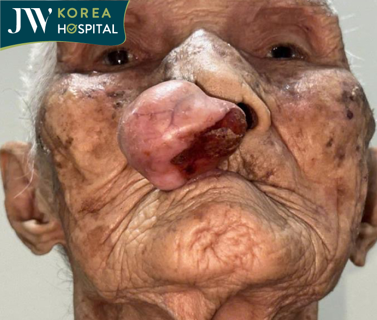 Cụ bà 100 tuổi phải mang khối u mạch máu suốt hơn 30 năm