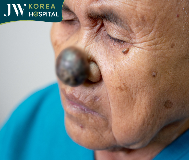 cận cảnh khối u của sư bà khơ_me1