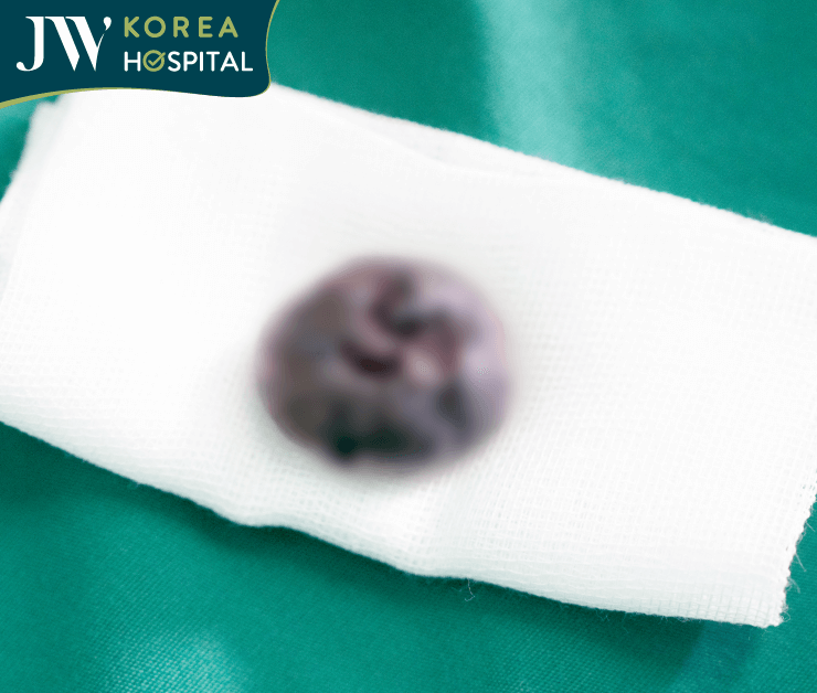 khối u melanoma của sư bà khơ-me