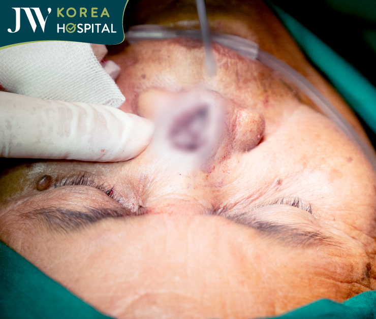 cận cảnh mũi bà sư khi vừa mổ xong