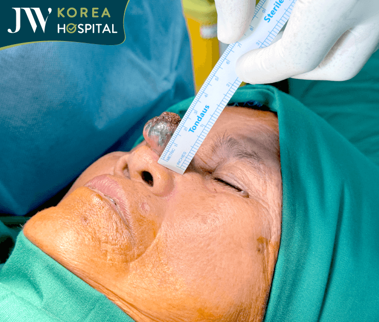 đo khối u melanoma của sư bà khơ-me