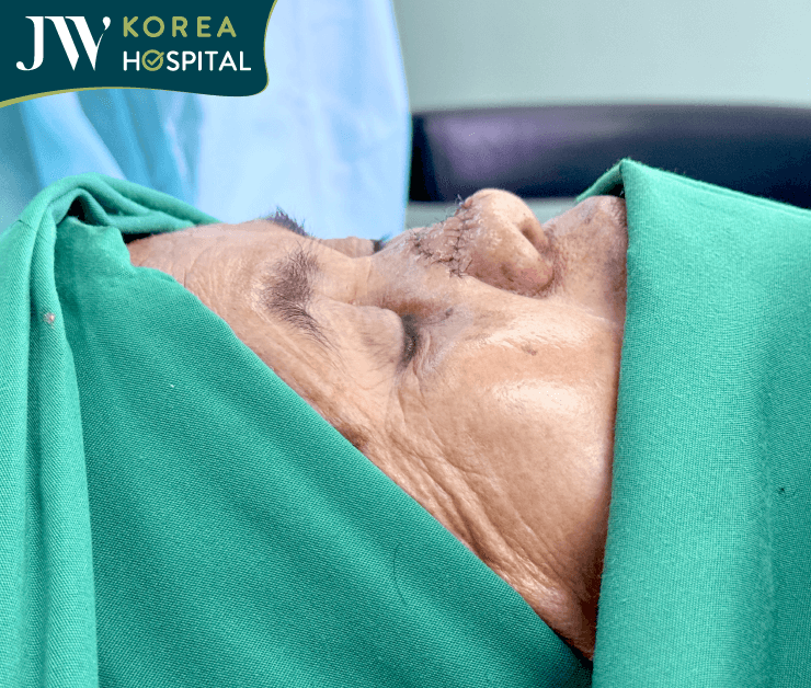 góc nghiêng sau khi phẫu thuật của sư bà Khơ-me