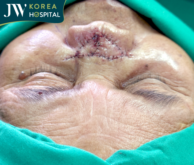 kết quả phẫu thuật cho bà sư 1