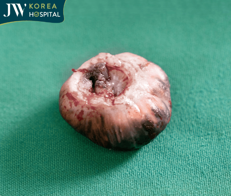 Khối U được tách ra thành công