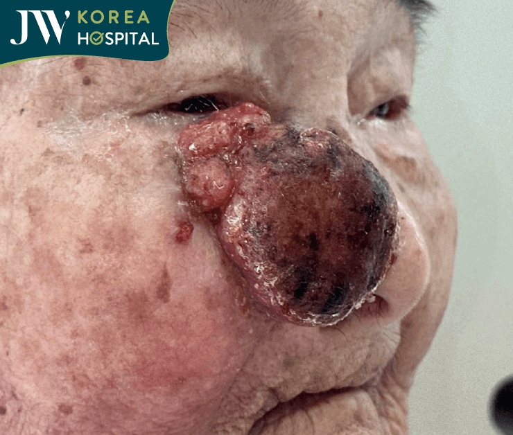 cận cảnh khối u máu của cụ bà 93 tuổi