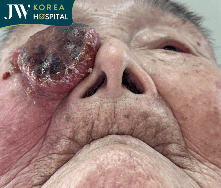 cận cảnh khối u máu của cụ bà 93 tuổi