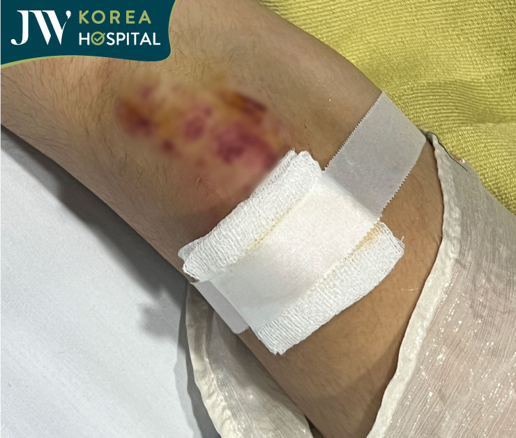 chân cô gái bị tai nạn giao thông do chó thả rong