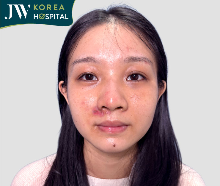 gương mặt cô gái bị tai nạn giao thông do chó thả rong sau khi đã được điều trị và hồi phục