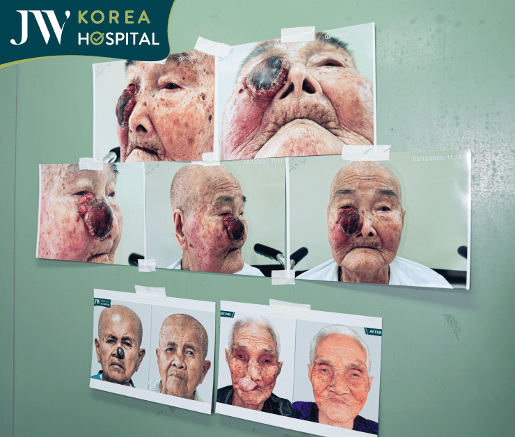 hình before của cụ bà và các ca mổ tương tự bác sĩ tú dung đã mổ