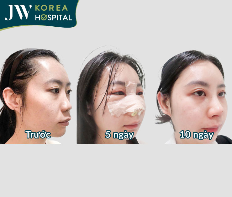 Nâng mũi s line tại bệnh viện JW sau 10 ngày