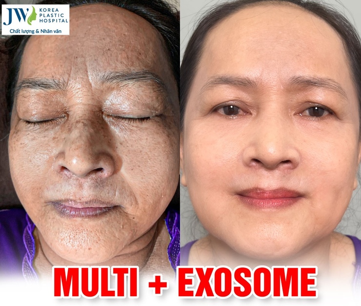 khách hàng sau khi sử dụng exosome