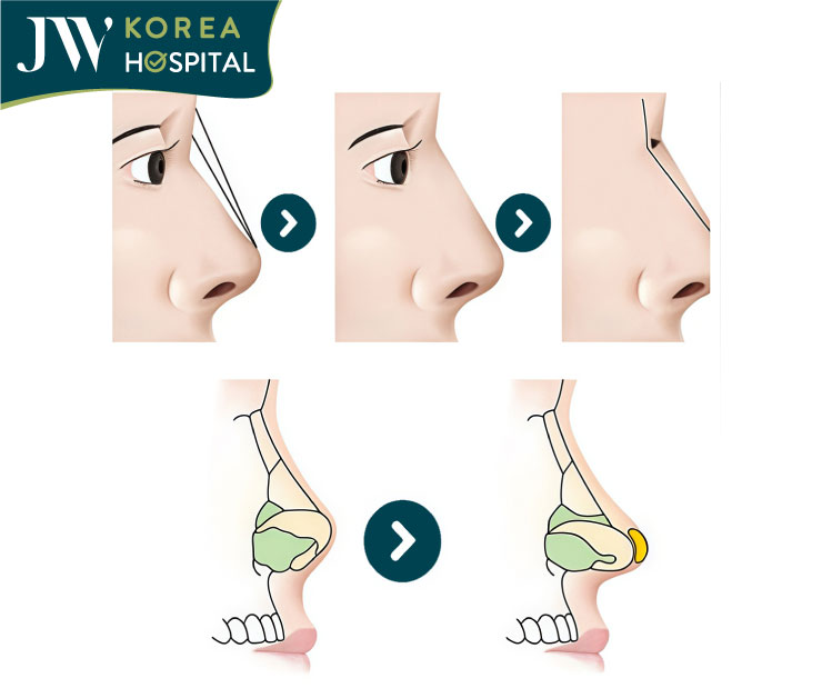 mô phỏng nâng mũi s line tại bệnh viện jw