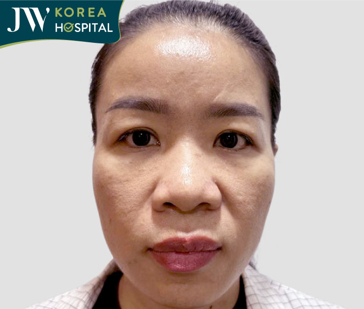 trước khi nâng mũi s line tại JW