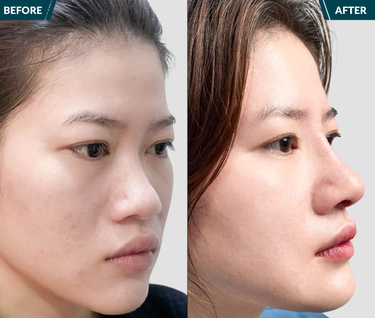 truoc-va-sau-khi-nang-mui-s-line-1