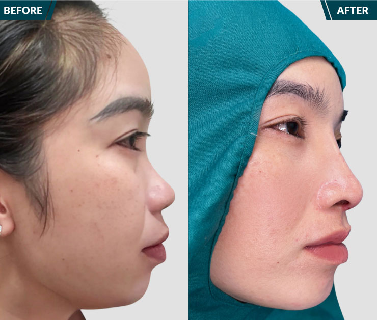 truoc-va-sau-khi-nang-mui-s-line