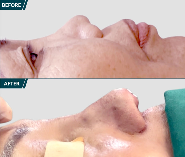 truoc-va-sau-khi-nang-mui-s-line-2