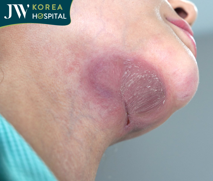 biến chứng cằm do làm đẹp nhanh