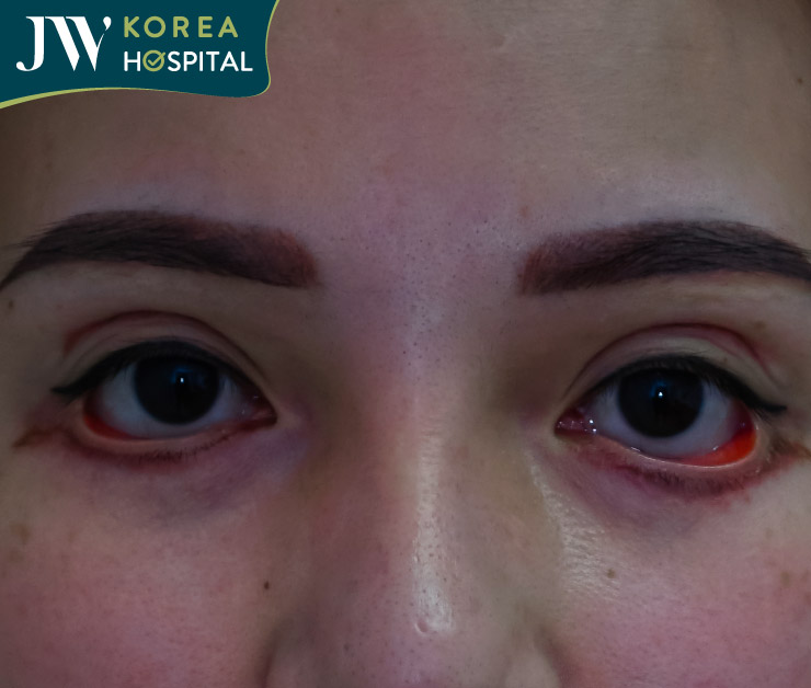 biến chứng cắt mắt do làm đẹp tại cơ sở không uy tín