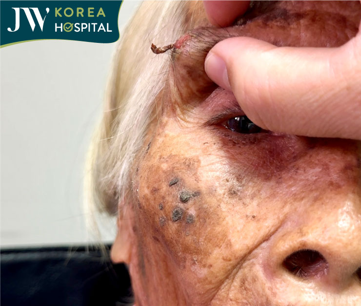 cận cảnh khối u ngay chân mày của cụ bà 90 tuổi 2