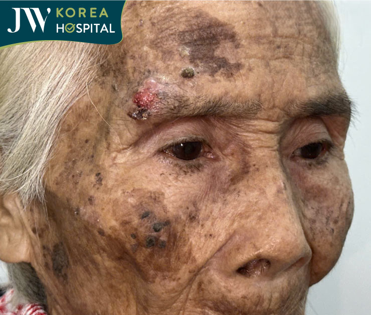 cận cảnh khối u ngay chân mày của cụ bà 90 tuổi 1