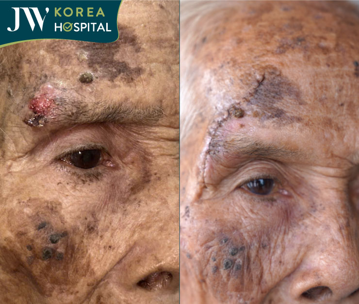 hình ảnh tước và sau khi cắt u miễn phí